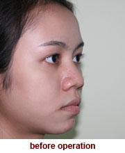 plastic_surgery_augmentation_rhinoplasty